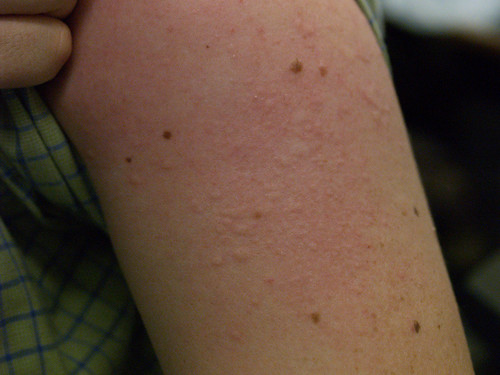 Hives rash on legs